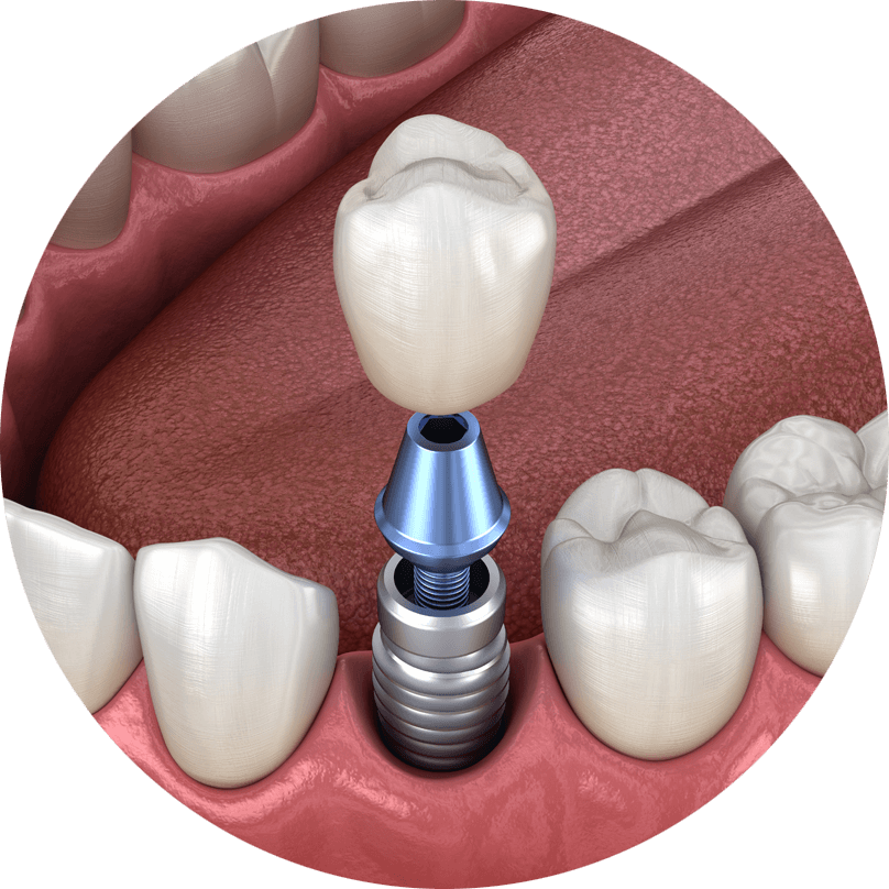 dental implant model