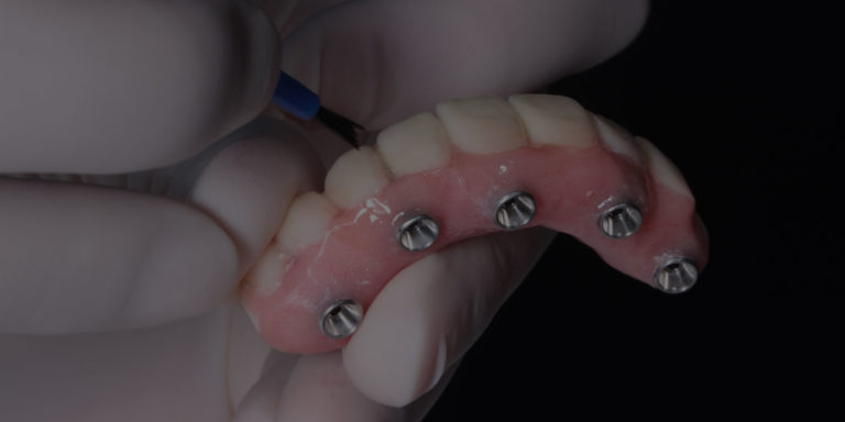 full arch dental implants model