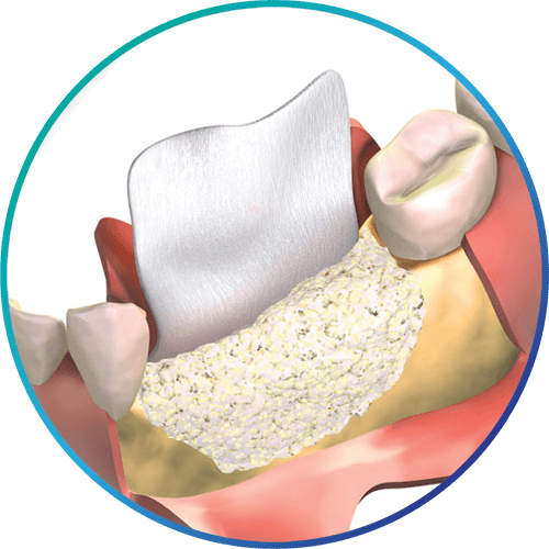 guided tissue regeneration graphic