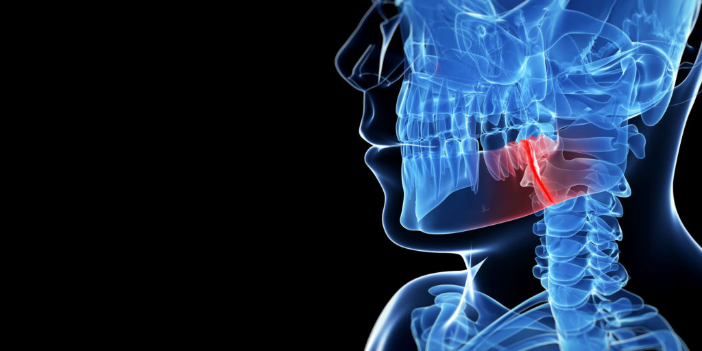 jaw bone fracture graphic