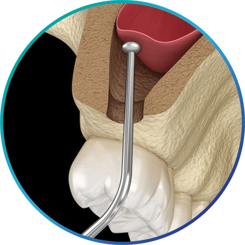 sinus lift graphic