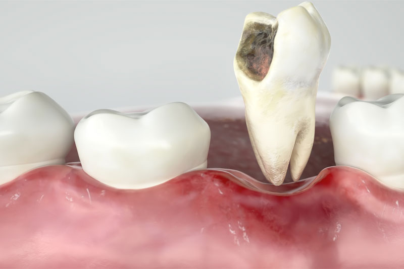 damaged tooth graphic