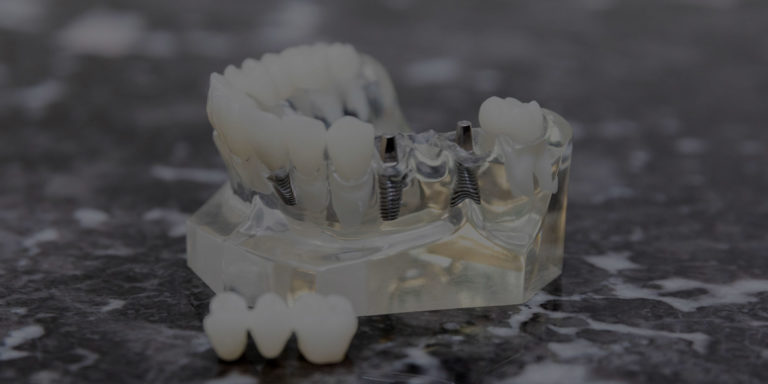 dental implant model