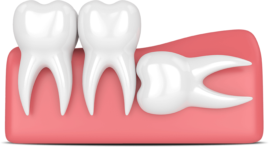 impacted tooth model