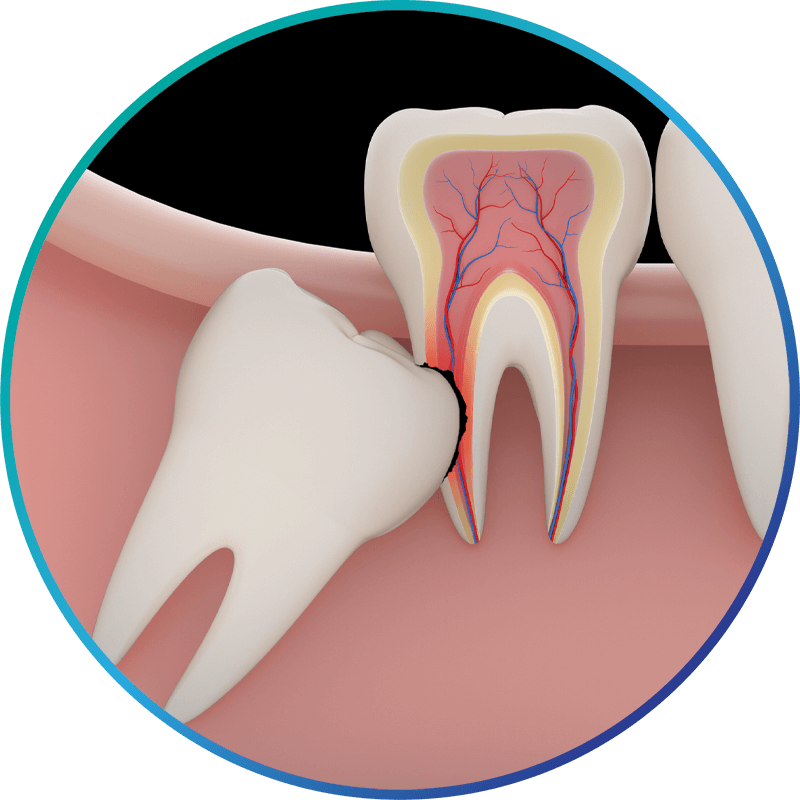 an impacted wisdom tooth damaging a second molar