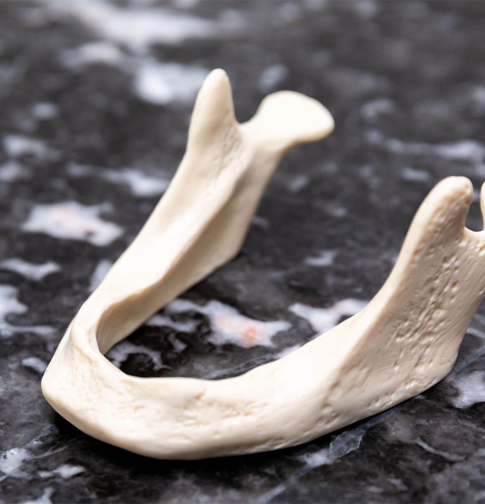 jaw bone loss model