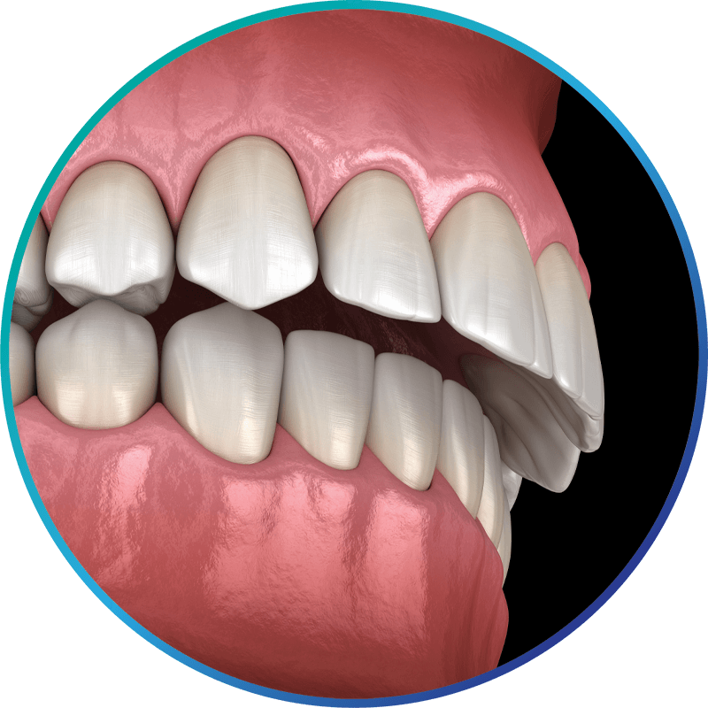 misalign jaw model