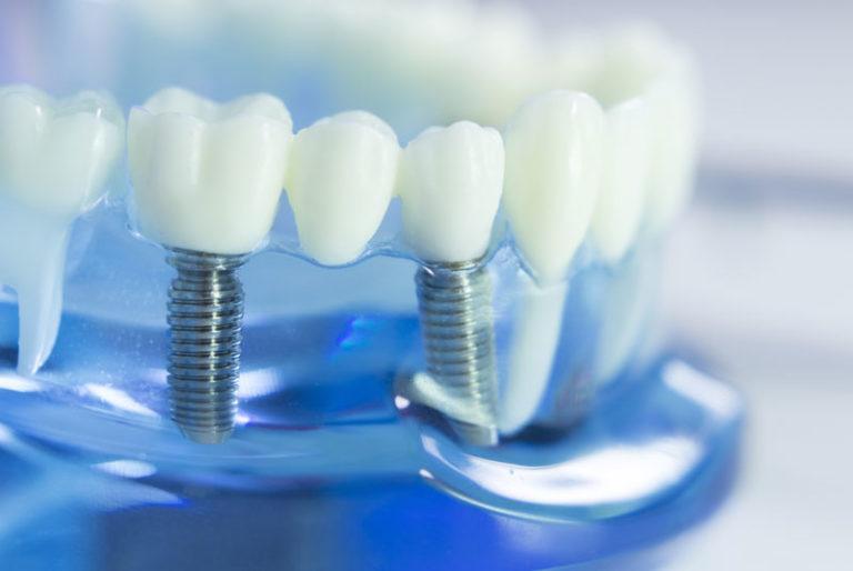 a dental implant model that can be used by an oral surgeon to show people how dental implants can restore their smiles.
