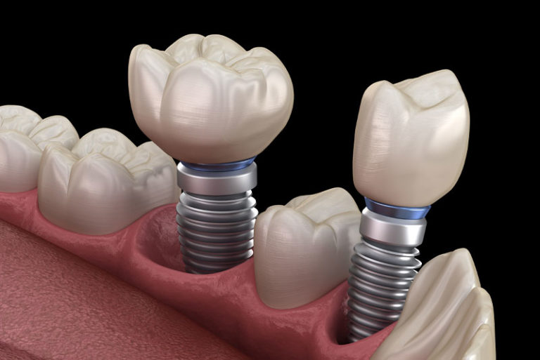 Two Single Dental Implants In A Gumline