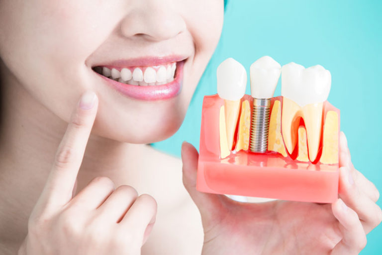 Dental Patient Happily Holding Up A Dental Implant Model, And Pointing to Her Smile