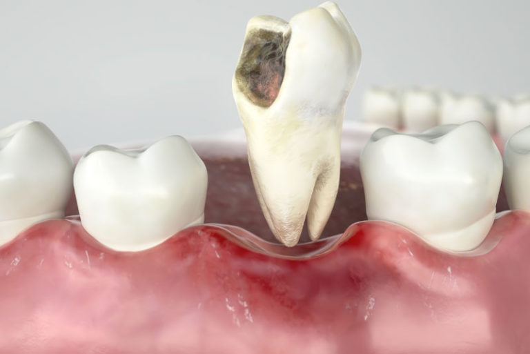 Damaged Tooth Being Pulled Out Of Gums