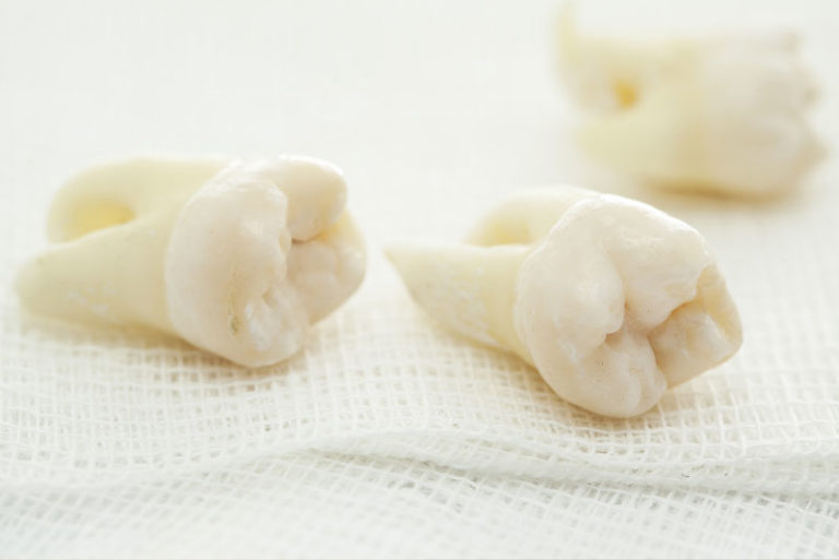 Model Of A Wisdom Tooth
