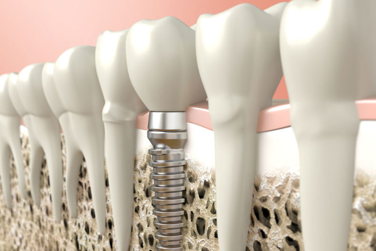 Dental Implants In Your Jaw Bone Surrounded By Natural Teeth