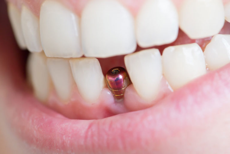 Dental Implant Post In A Dental Patient's Lower Front Jaw