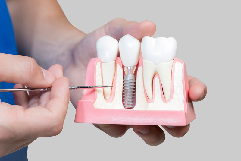 Dental Assistant Showing Off A Dental Implant In A Jawbone Cutaway Model in Denton, TX