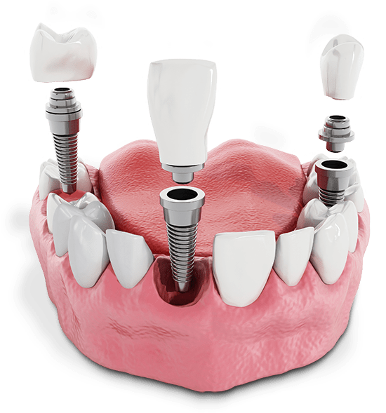 a model of three dental implants being placed