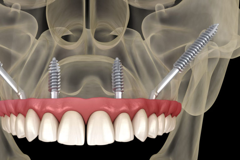 Zygomatic Dental Implants In A Dental Patient's Skull
