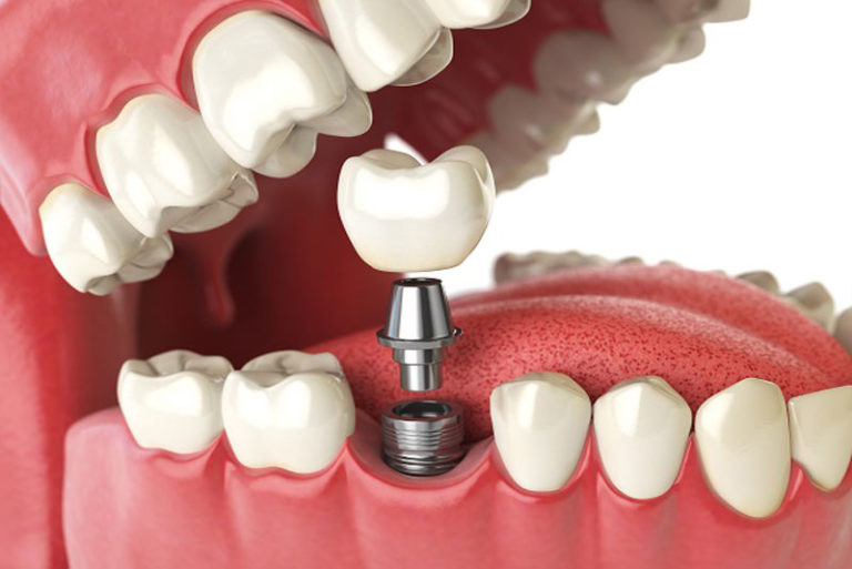 single dental implant model presentation