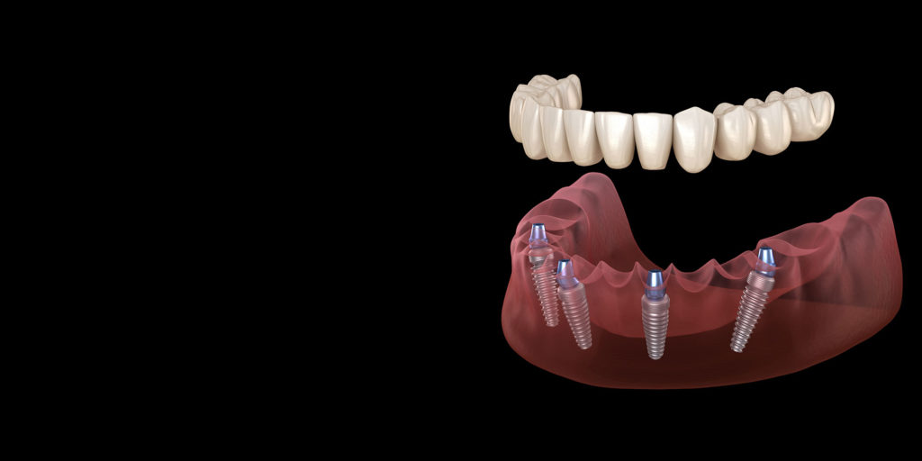 Full mouth dental implants