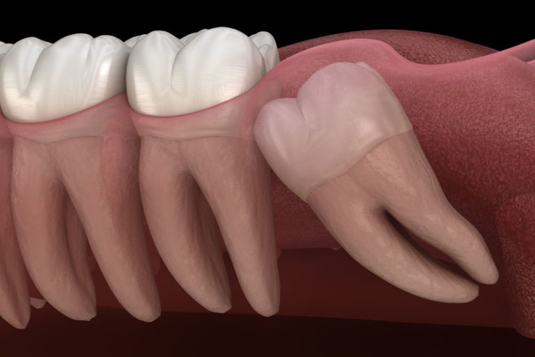 model of a wisdom tooth under the gum-line that is impacted and needs to be removed