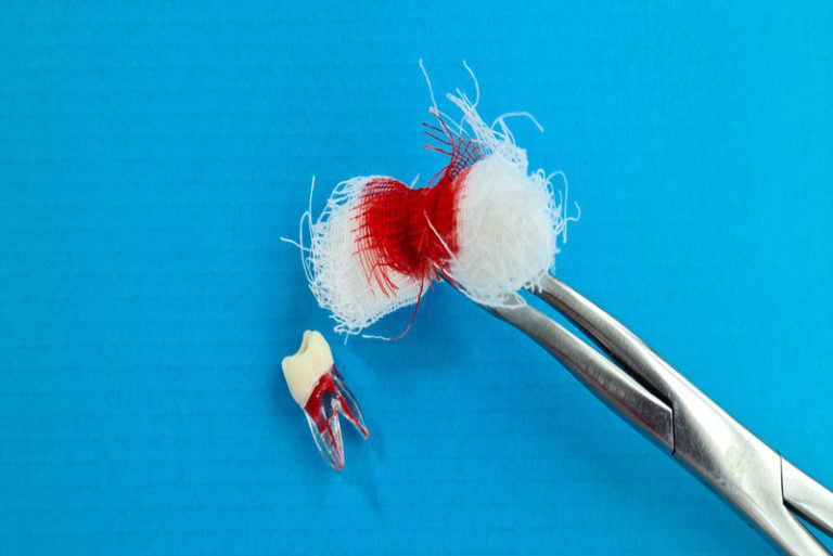 a single wisdom tooth after a successful tooth extraction.