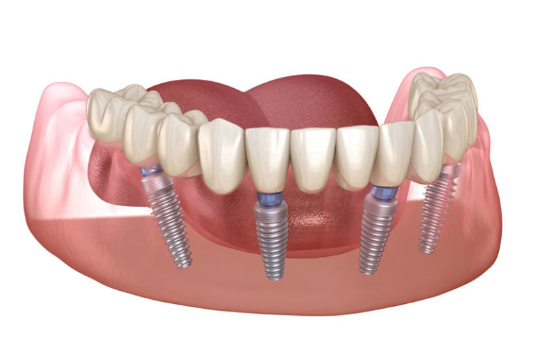 an image of an all-on-4 dental implant model showing four dental implant posts going into the gums with the dentures hovering over the top.