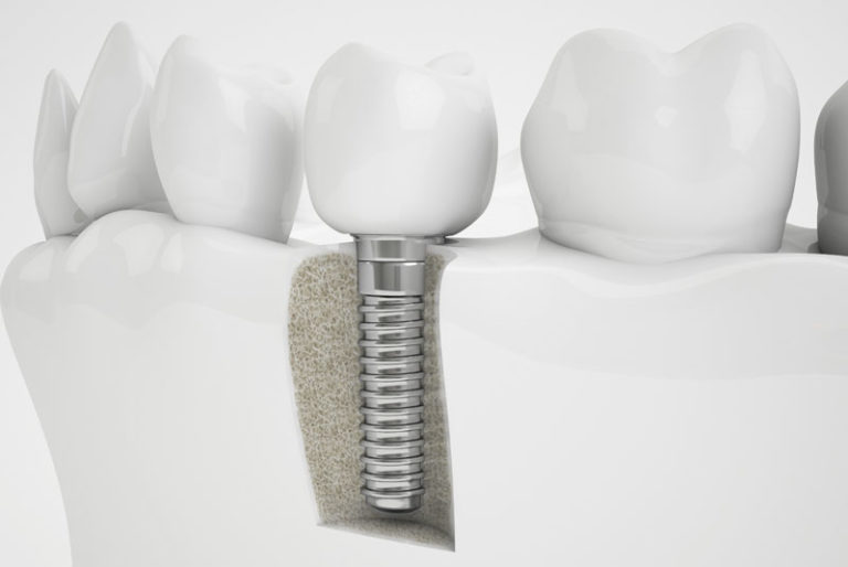an image of a dental implant placed in a jawbone where a bone grafting treatment was performed.