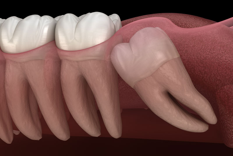 an impacted wisdom tooth model