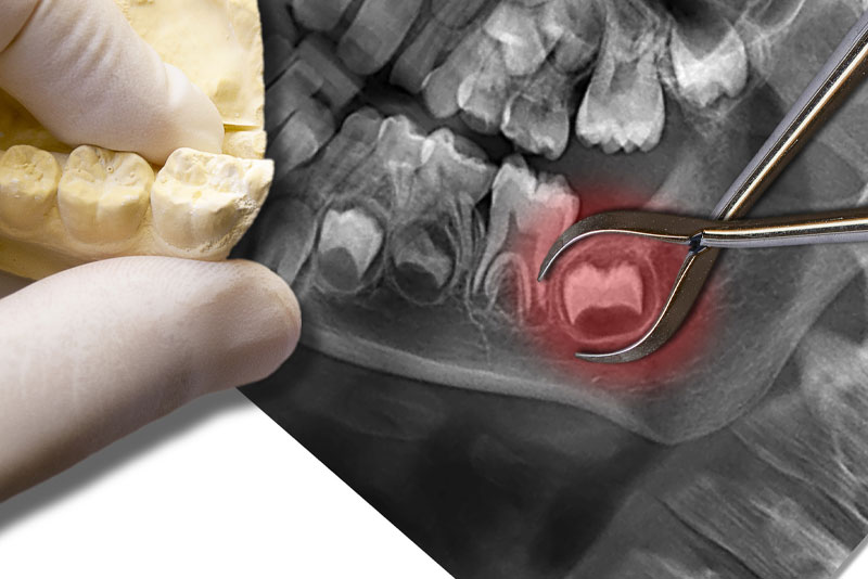 an impacted wisdom tooth exray and totoh model.