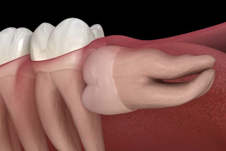 An image of an impacted wisdom tooth.