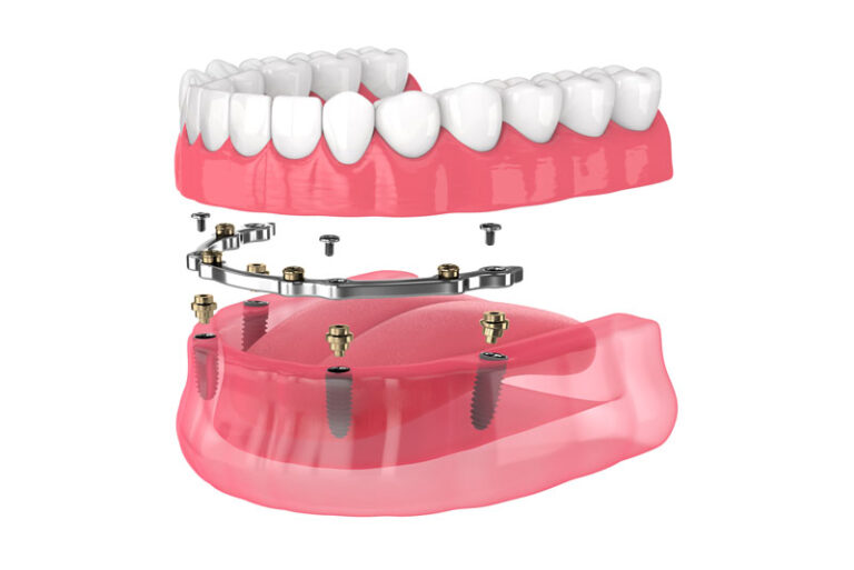 dental implant model - full mouth dental implants.