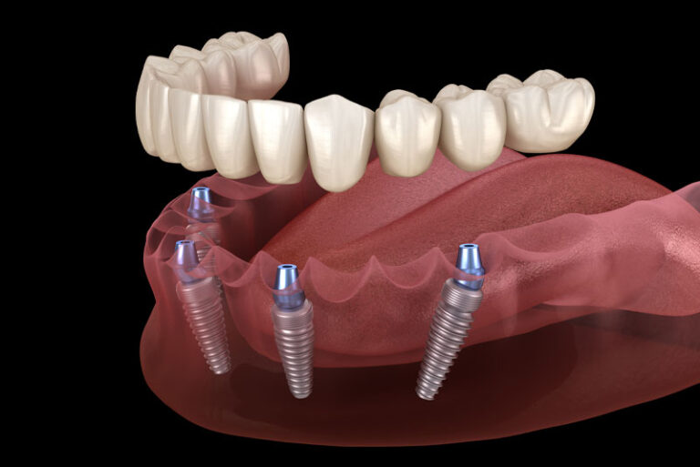 a full arch dental implant model that shows how the dental implant posts, abutments, and prosthesis can be accurately placed with InstaRisa's 3.0 3D facial scanner.