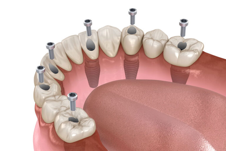 a bottom full arch dental implant model that shows how dental implants and a prosthesis can be placed for a full mouth dental implant procedure, after additional procedures are performed.