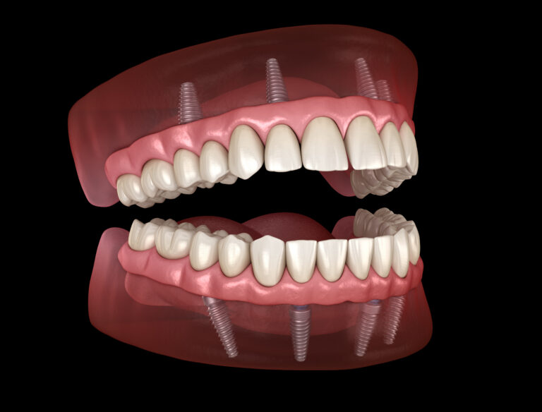 image of an all on 4 dental implants 3D model.