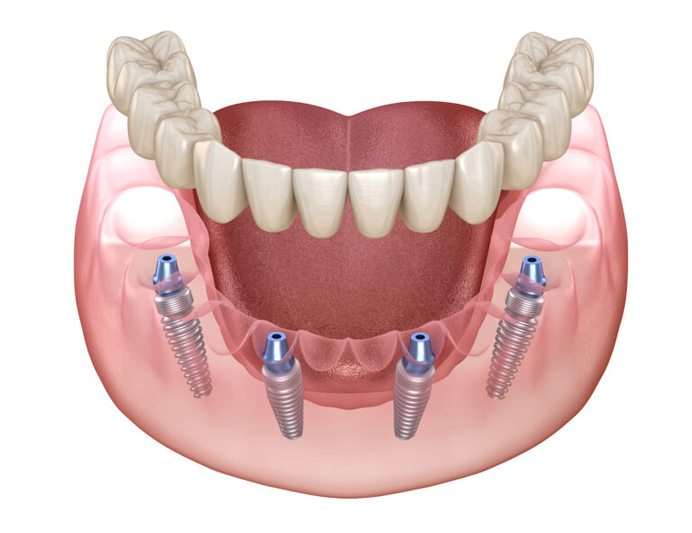 an image of full mouth dental implants.