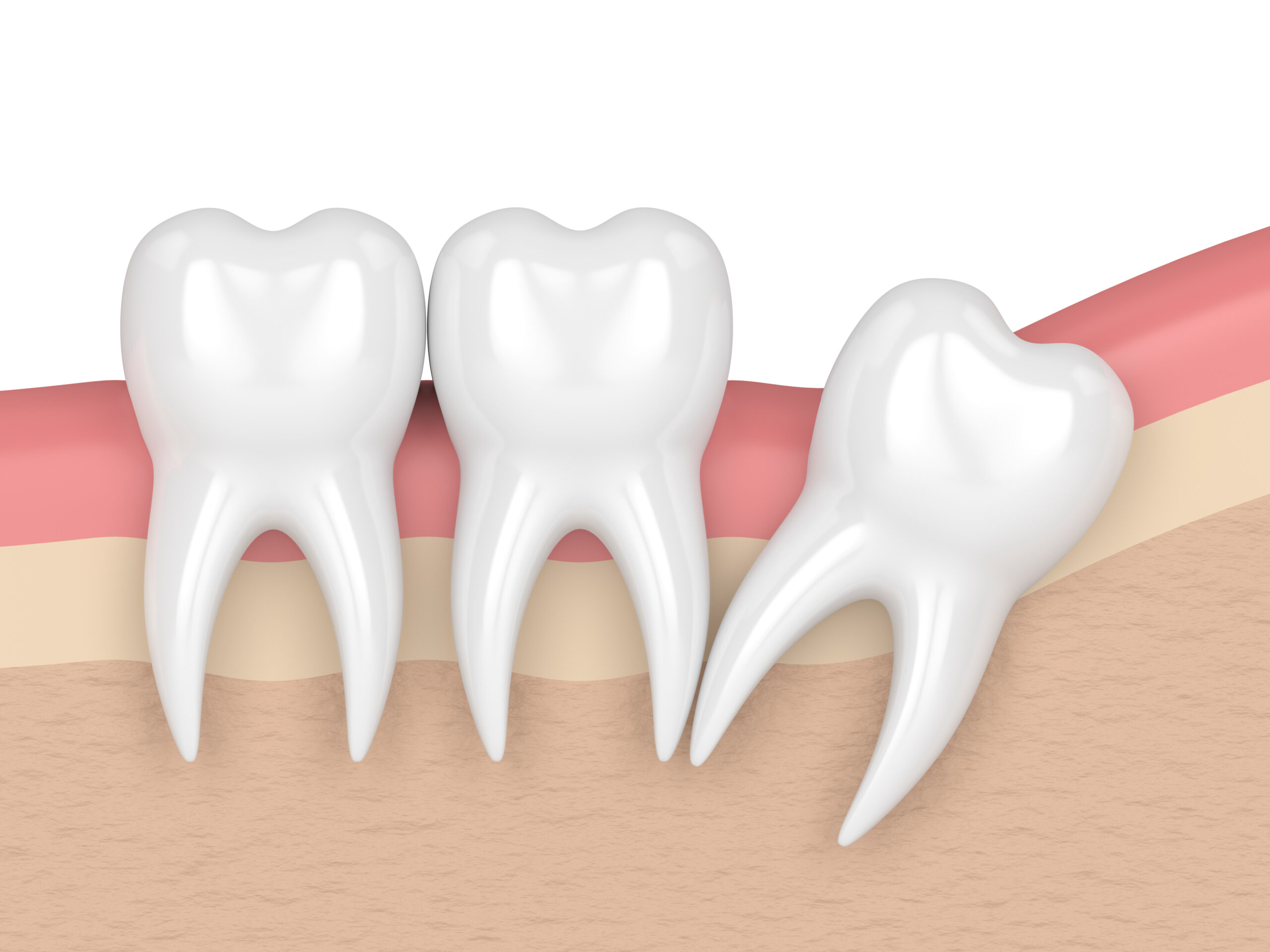 3d render of teeth with wisdom distal impaction.
