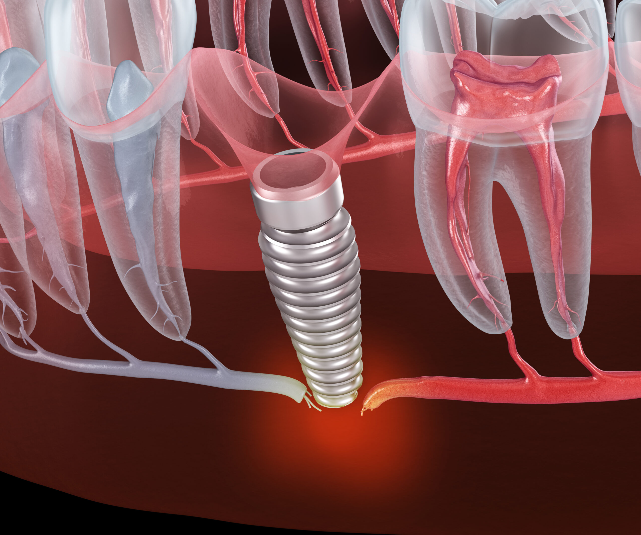 Result of unsuccessful dental implantation - nerve break. Medically accurate dental 3D illustration.