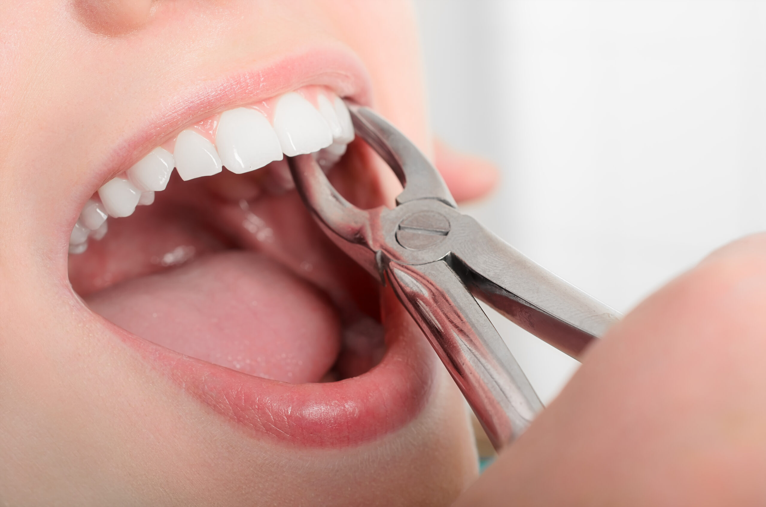 an image of a tooth extraction.