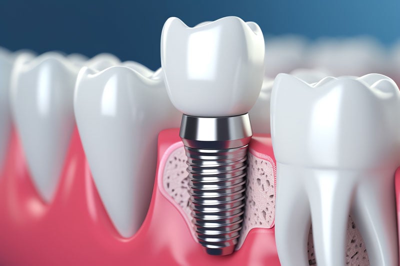 What Does The Dental Implant Post Part Of A Dental Implant Do? Texas