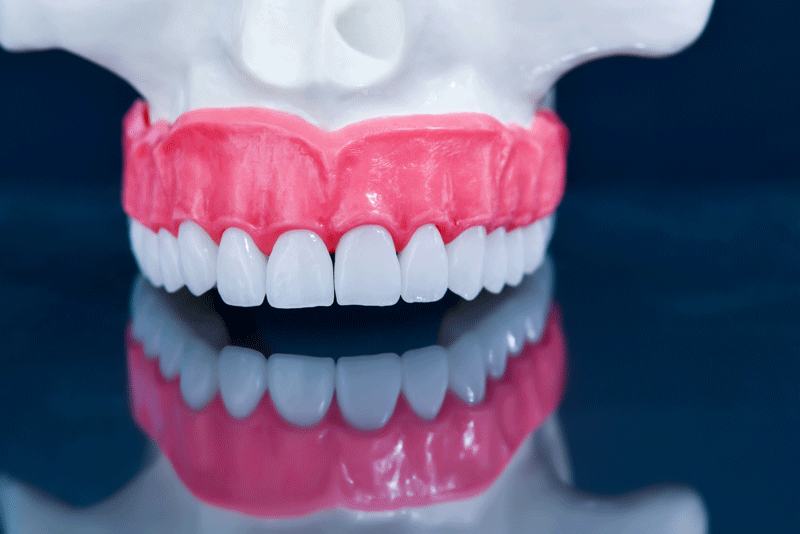 a full mouth dental implant model.