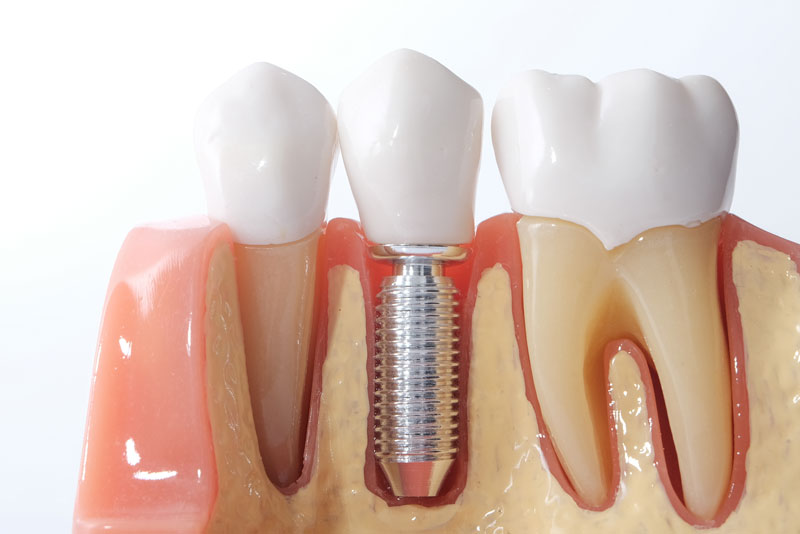 a dental implant model bone cutaway showing the dental implant post.