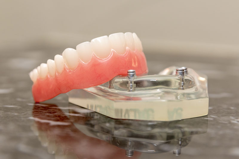 Showcasing a top view of an All-on-4 dental implant model, demonstrating how four titanium posts are precisely implanted into the jawbone to support a full arch of prosthetic teeth, highlighting the innovative solution for full mouth rehabilitation.