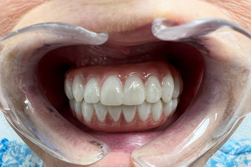 a patient that received a full arch of teeth with texas oral surgery