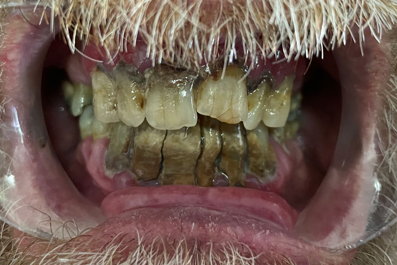 severely rotten teeth with severe gum decay and full mouth repair needed