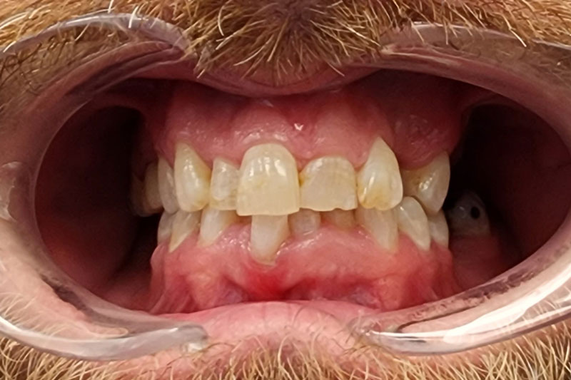 a patient at texas oral surgery with ground down teeth and yellowing