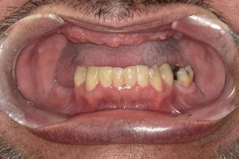 a patient with a missing set of teeth on top and damaged teeth on the bottom