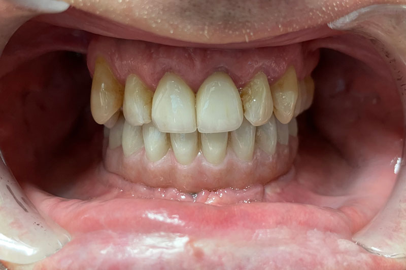 a bottom arch of teeth with implants holding it in and enhancing the smile of the patient