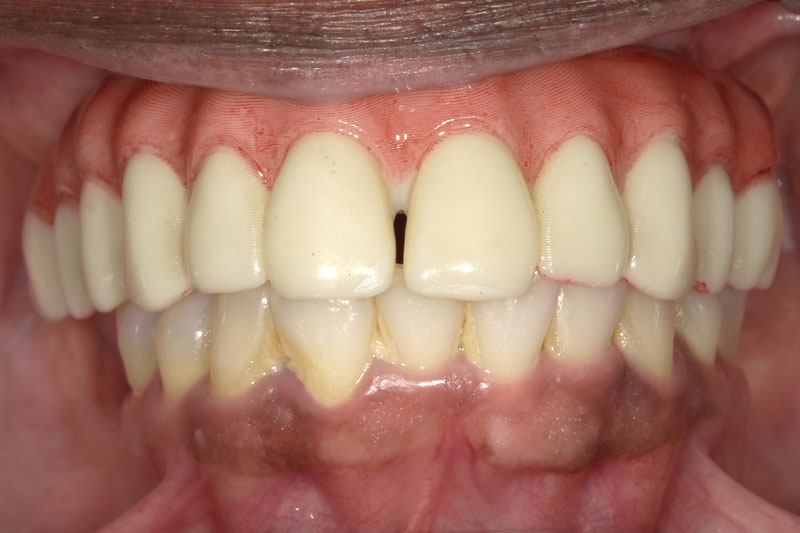 a full arch of teeth on top with an over crowding issue fixed