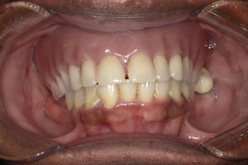 a patient with a top denture coming in for a full arch of teeth and overcrowding issues