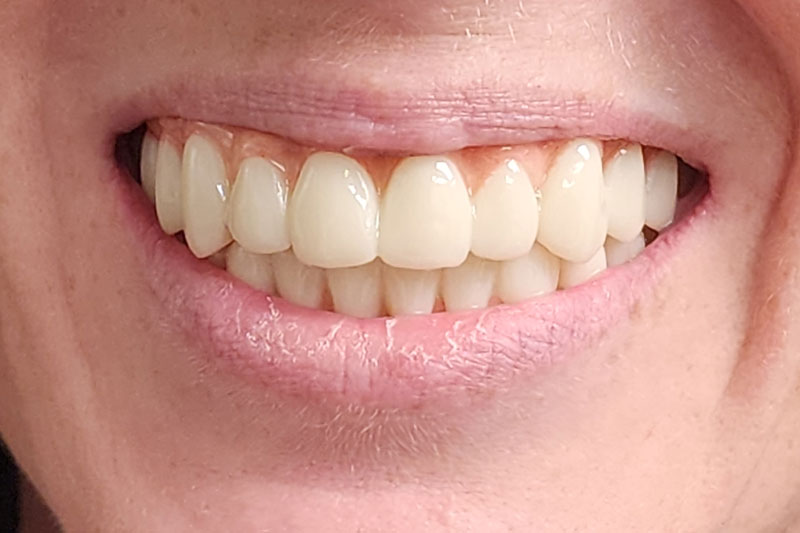 a patient with a full arch of teeth on top and bottom